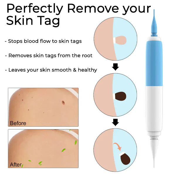 GlowEssence™ — Painlessly Banish Skin Tags in Just Days